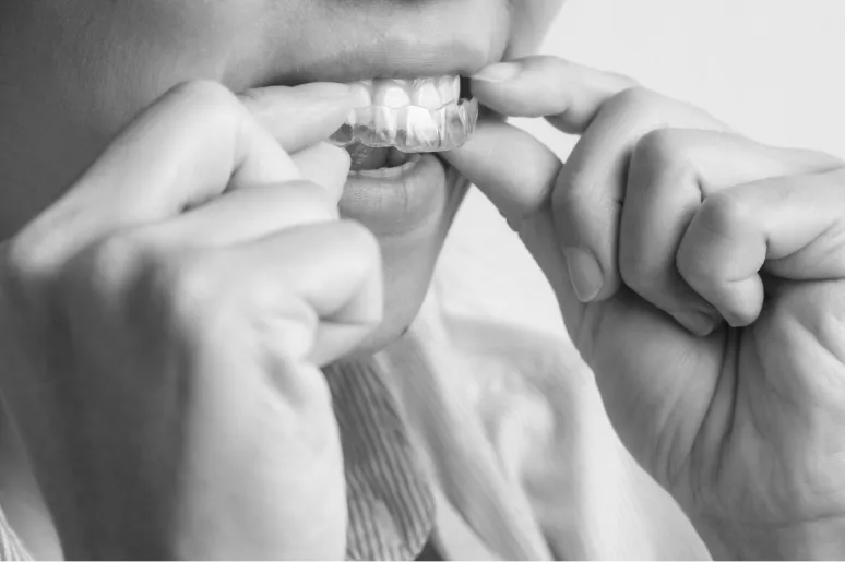 Invisalign clear aligners