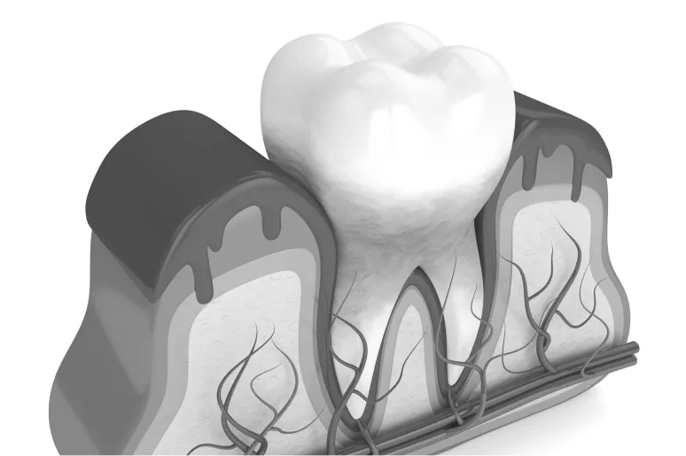 Periodontal disease treatment