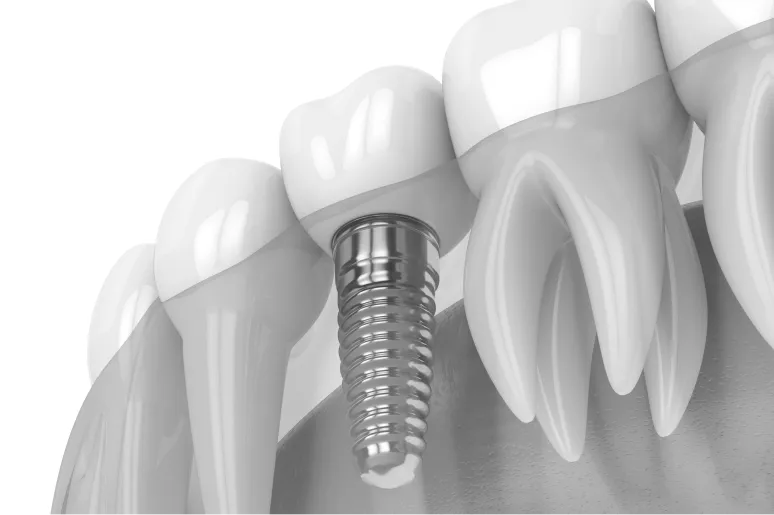 Dental implants