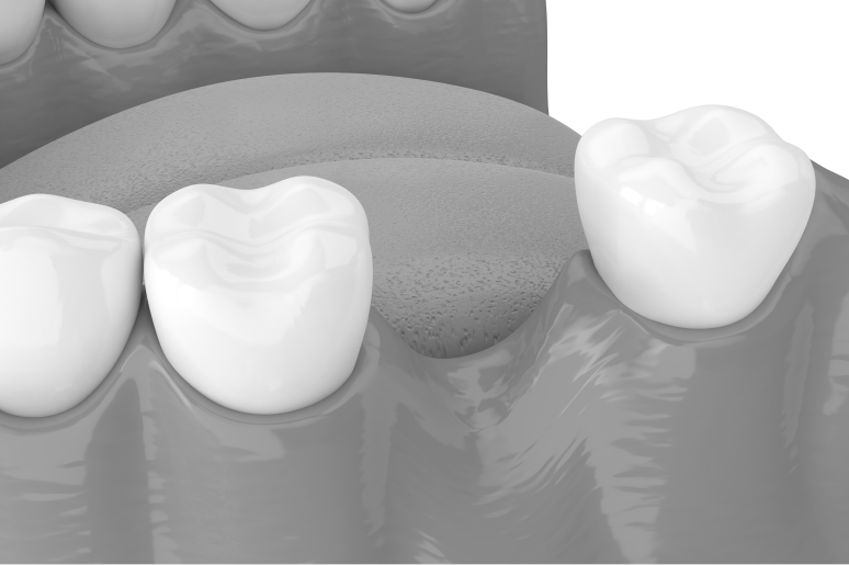 False teeth dentures